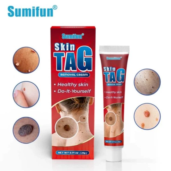 Skin tag removal cream